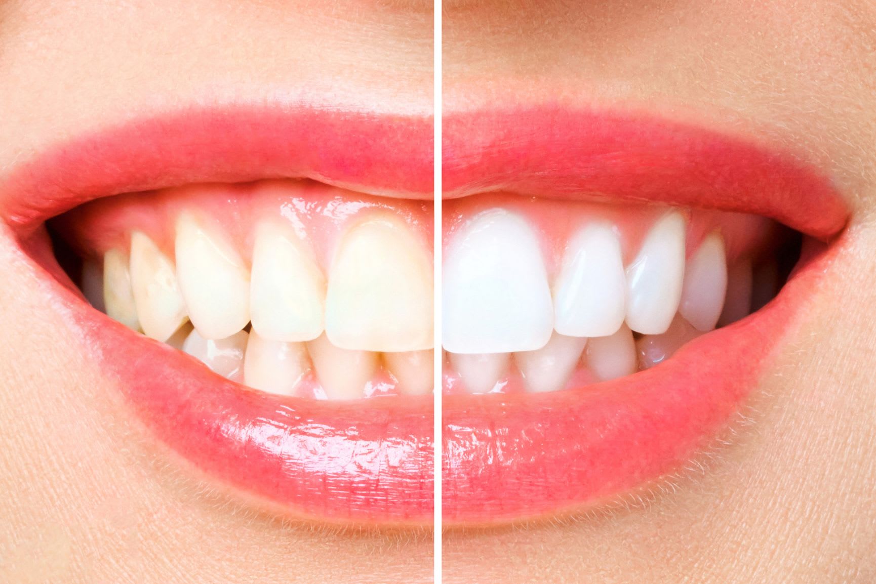 Pro Glow Teeth Whitening Read Reviews and Book Classes on ClassPass