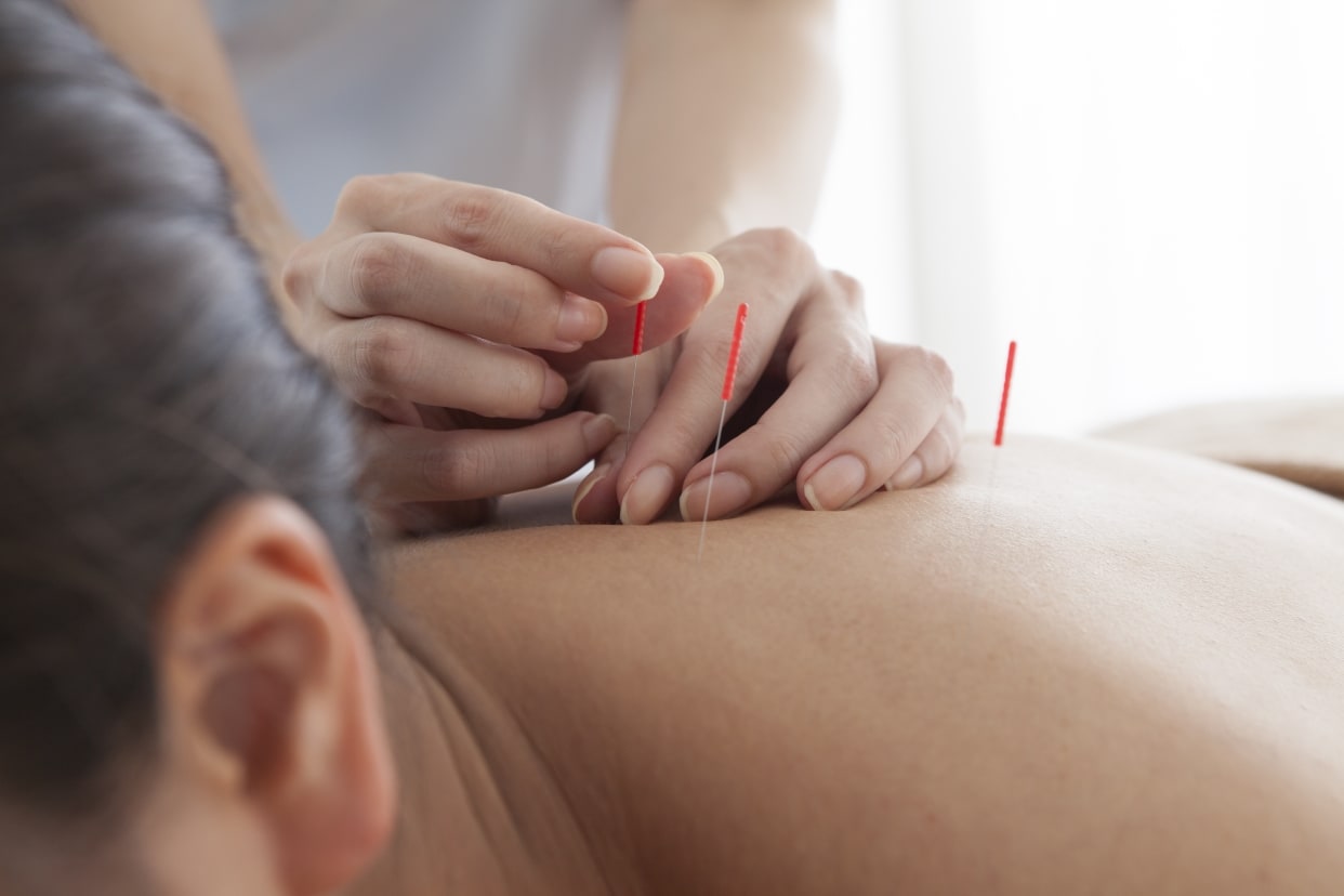 NOVA Acupuncture: Read Reviews and Book Classes on ClassPass